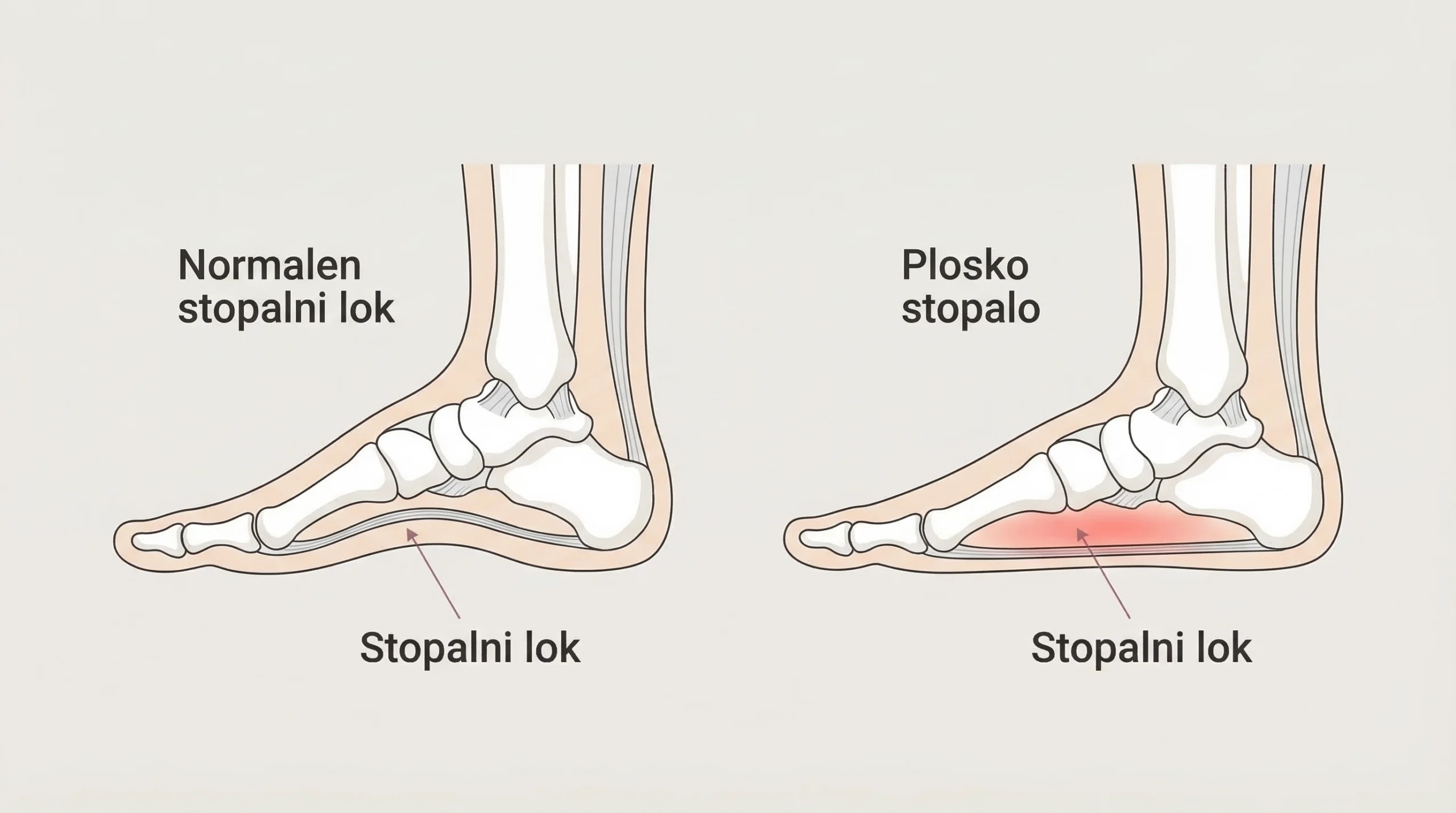 plosko stopalo prikaz primerjave normalnega in spuščenega stopalnega loka