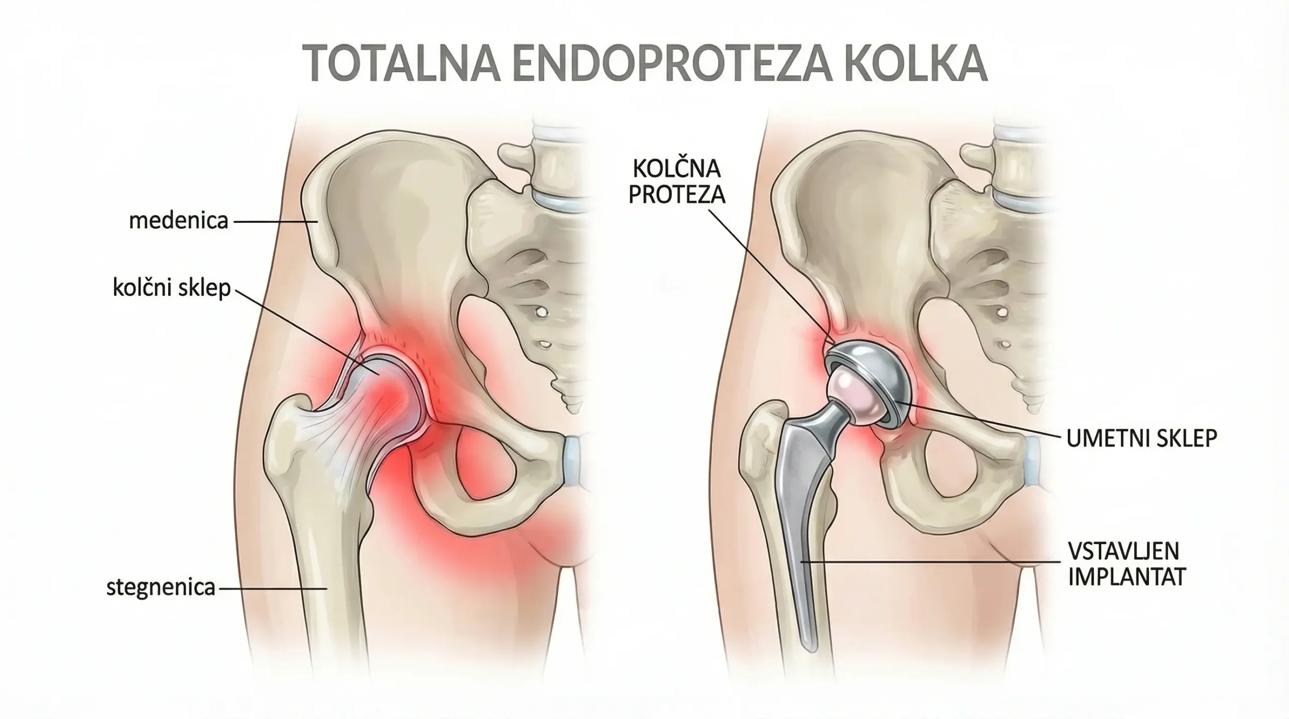 totalna endoproteza kolka ilustracija kolčna proteza umetni sklep stegnenica medenica operacija kolka