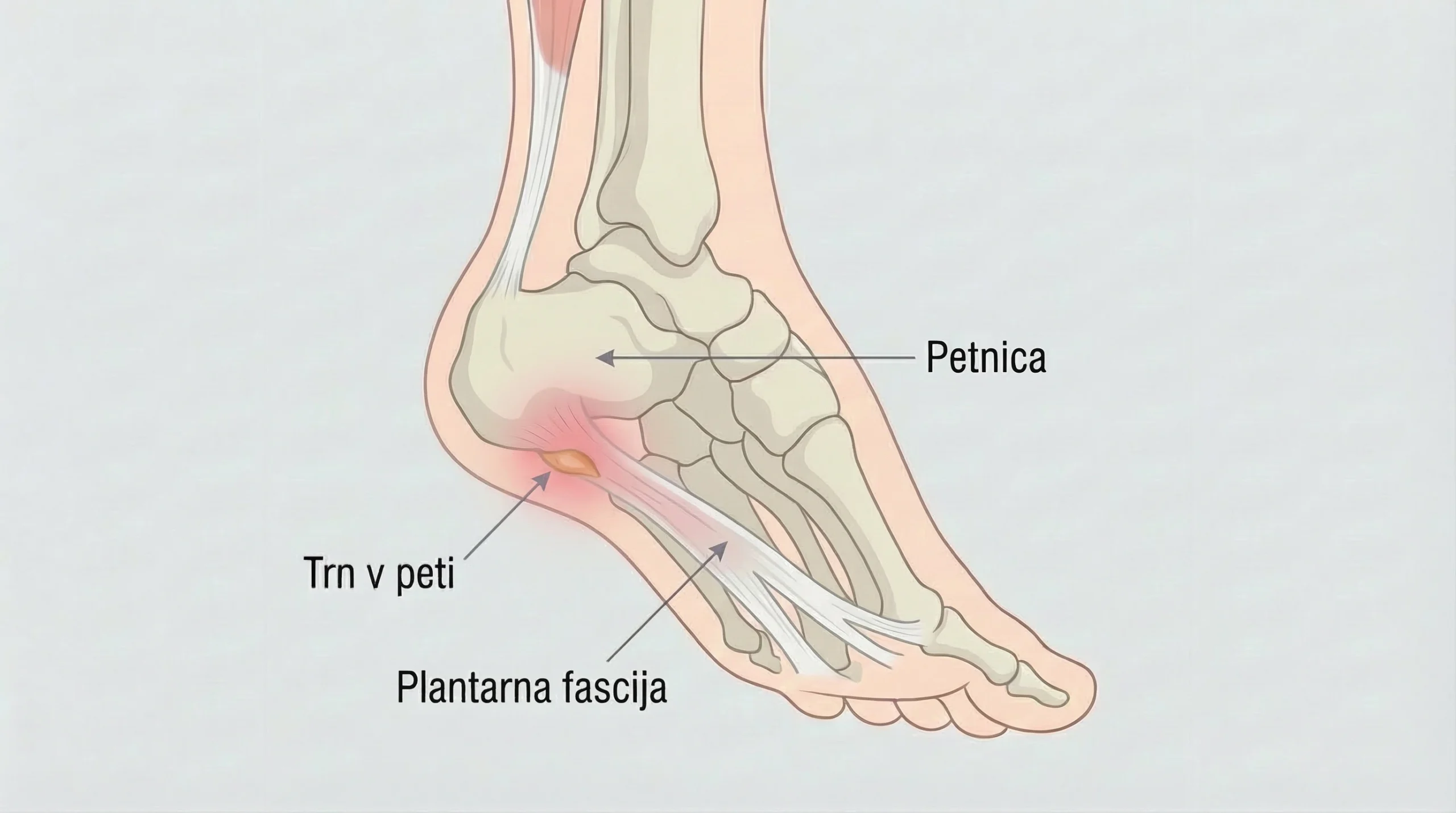 trn v peti prikaz anatomije stopala z vneto plantarno fascijo